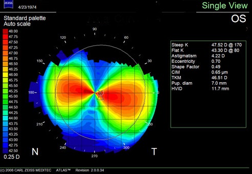 corneal topography