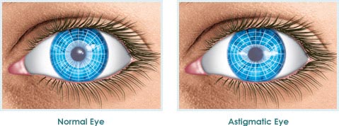 Astigmatism - A Common Condition of the Eye