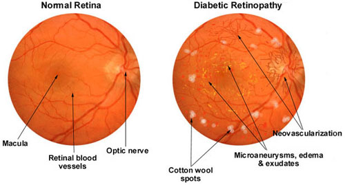 Diabetic retinopathy